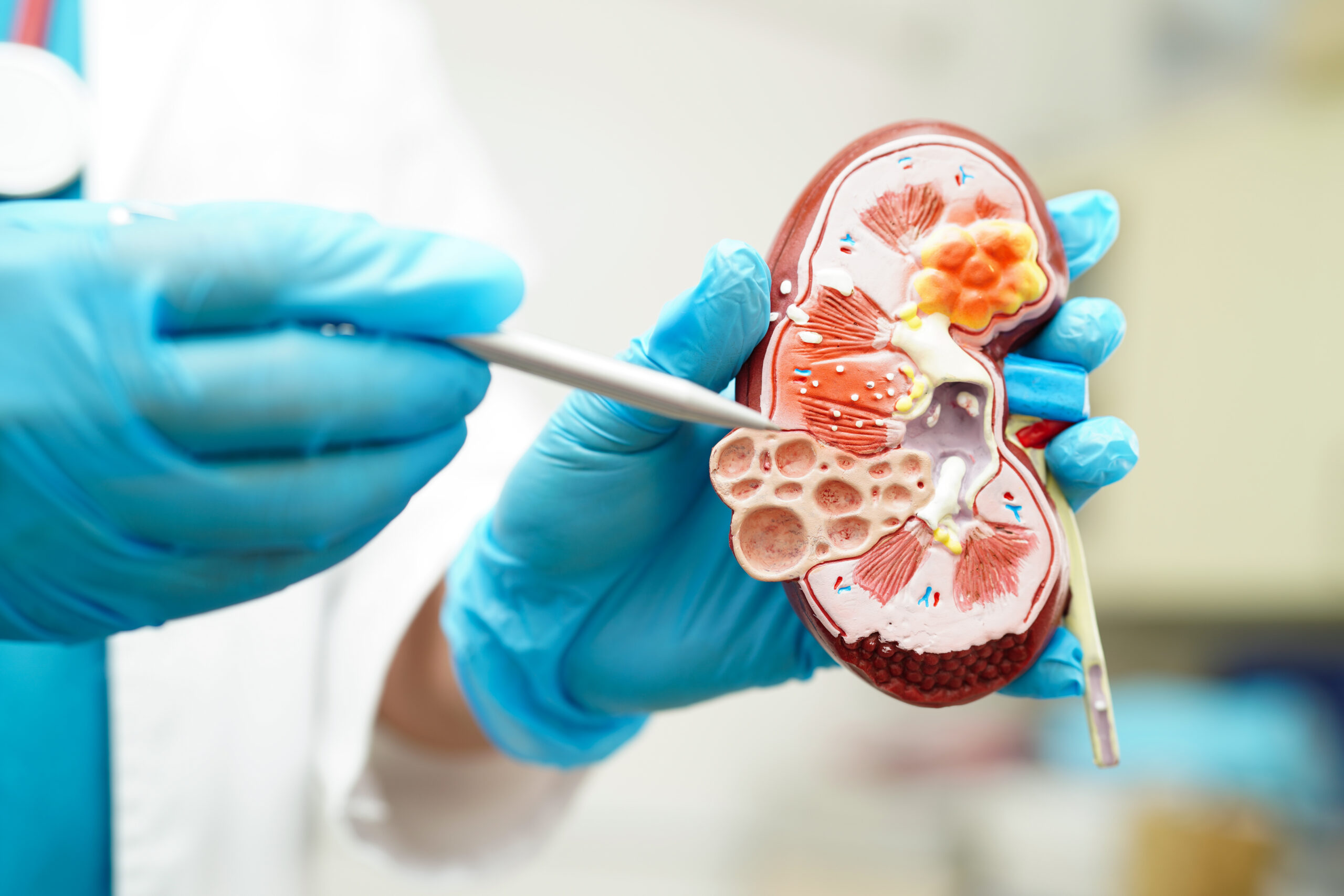 Calculo renal o que causa e como previnir dra mayara bueno nefrologista sorocaba